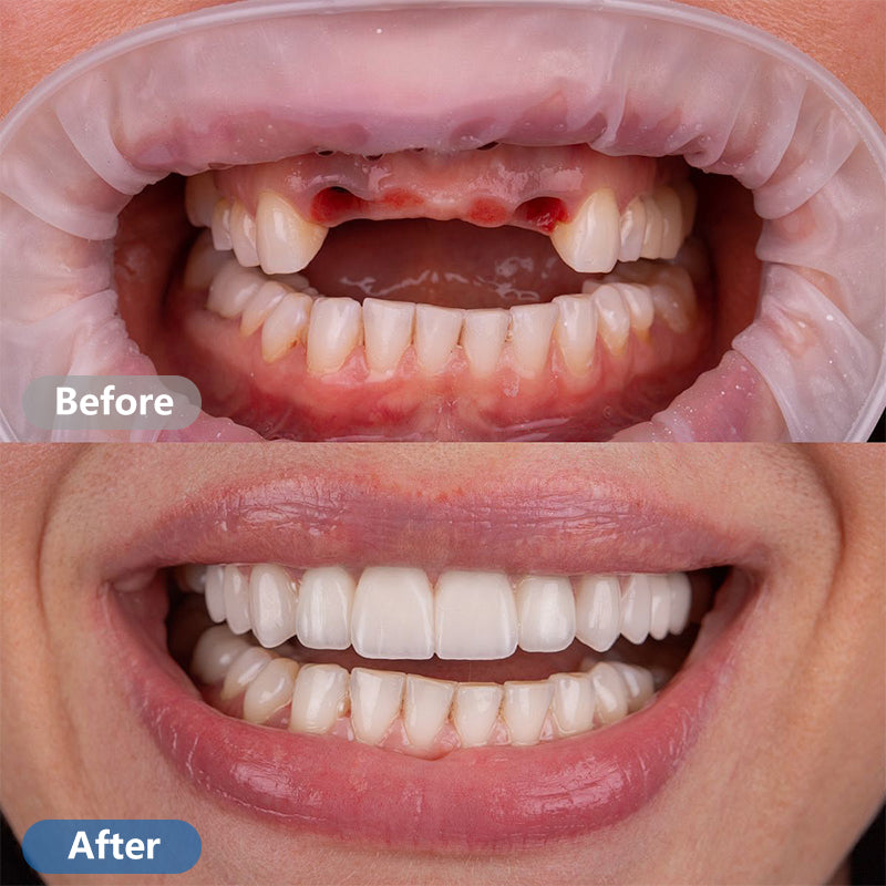 Dental Restoration Kit – Mouldable Dentures for Instant Smile Fix, Temporary Tooth Replacement, Ideal for Halloween & Party Makeup