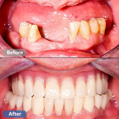 Dental Restoration Kit – Mouldable Dentures for Instant Smile Fix, Temporary Tooth Replacement, Ideal for Halloween & Party Makeup